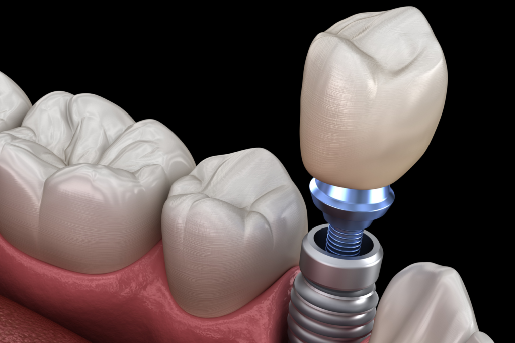 Implants-dentaire