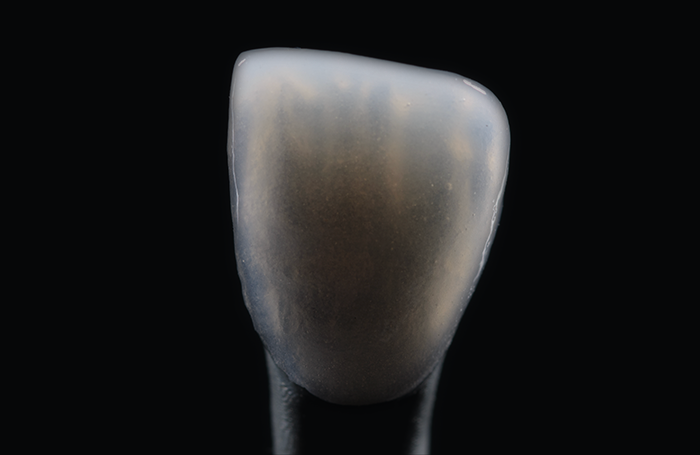 Couronne dentaire en céramique haute précision pour prothèse sur implant dentaire