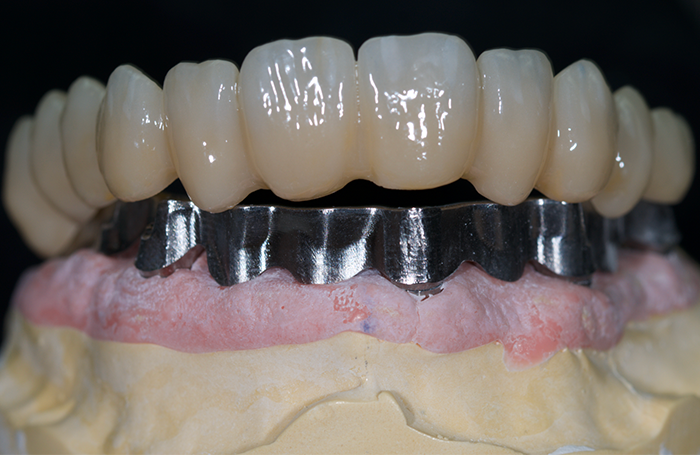 Prothèse sur implant dentaire avec armature métallique et couronnes céramiques sur modèle dentaire